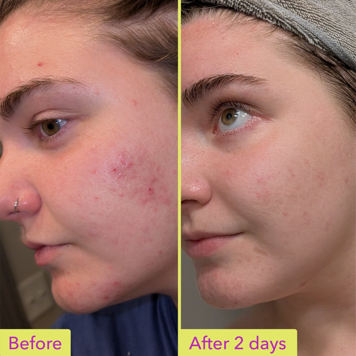 10-azelaic-acid-treatment-f3 zb_p.jpg