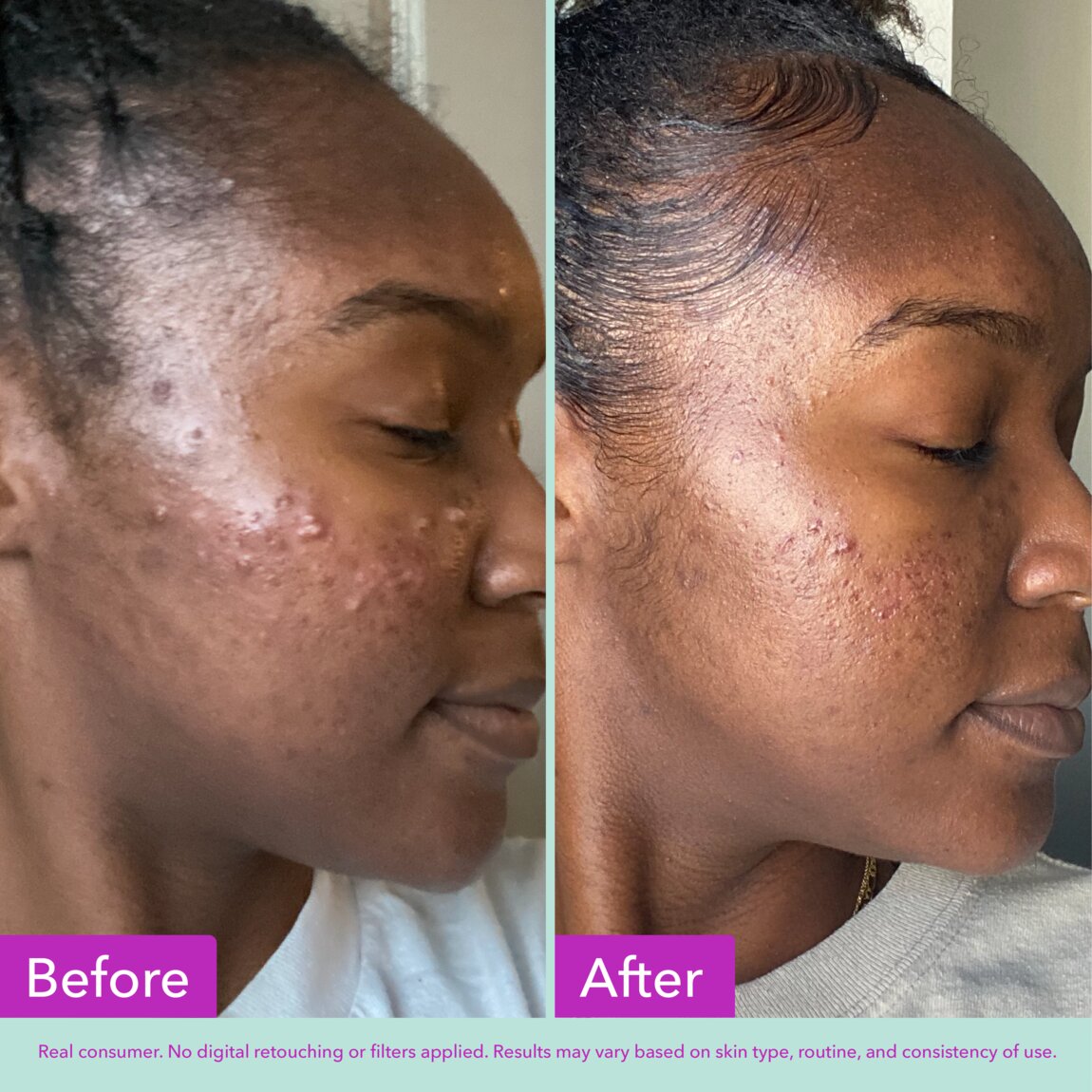 acne-foaming-cleanser-y1 zb_p.jpg